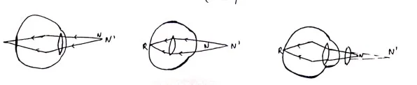 Class 12 Physics Chapter 9 Notes in Hindi किरण प्रकाशकीय एवं प्रकाशिक यंत्र 18 दूर दृष्टि दोष