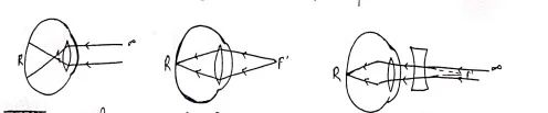 Class 12 Physics Chapter 9 Notes in Hindi किरण प्रकाशकीय एवं प्रकाशिक यंत्र 19 निकट दृष्टि दोष